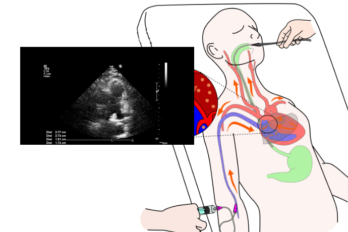 Diagrama de un ecocardiograma transesofágico aplicado a un paciente
