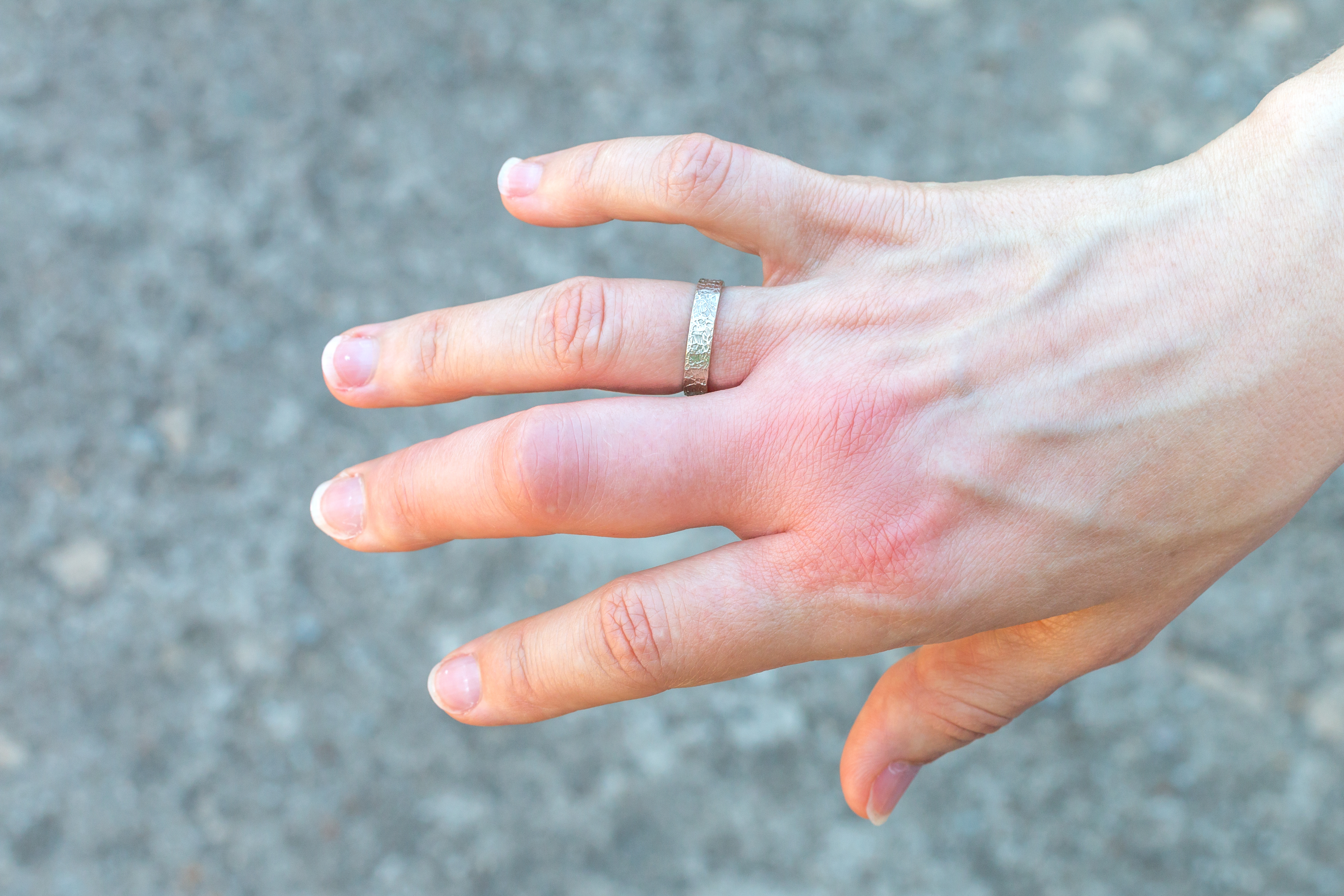 Mano de mujer cn anillo hinchada y enrojecida