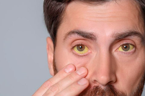 Posibles causas de los ojos amarillos