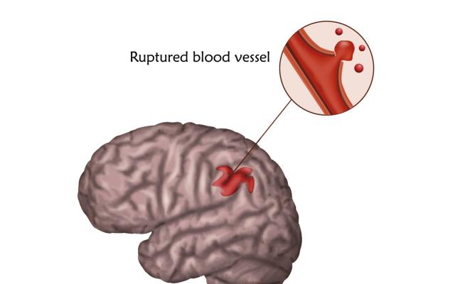 diagrama de hemorragia cerebral