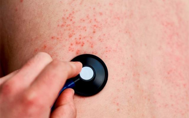 Sarampión: Prevención con Vacunas y Seguro Médico GMM