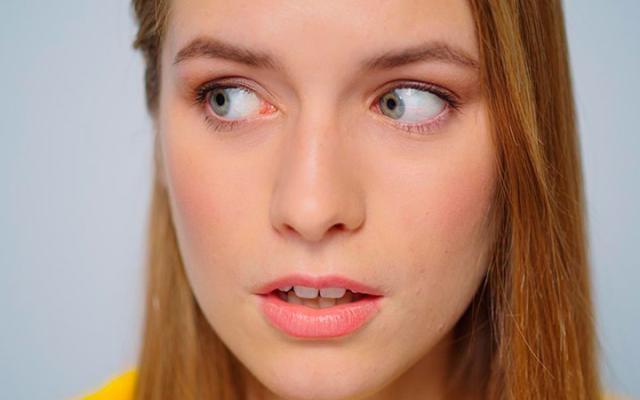 Ojos Amarillos: Por Qué este Síntoma Exige Atención