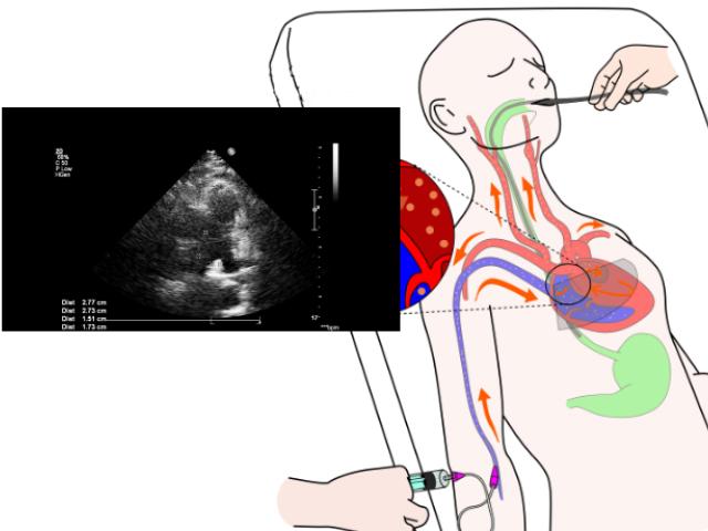 Diagrama de un ecocardiograma transesofágico aplicado a un paciente