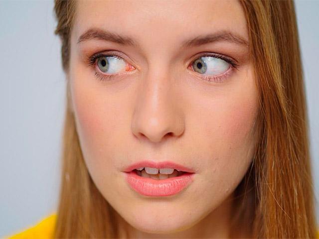 Ojos Amarillos: Por Qué este Síntoma Exige Atención