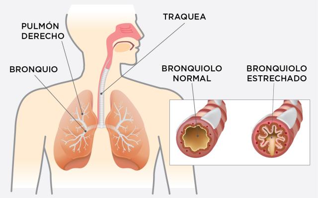 Sistema respiratorio - EPOC