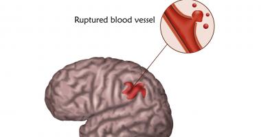 síntomas de accidente cerebrovascular cerebeloso emedicina diabetes