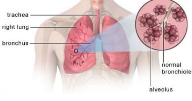 Hernia Umbilical Diagnostico Y Reparacion Bupa