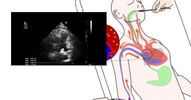 Diagrama de un ecocardiograma transesofágico aplicado a un paciente