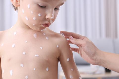 Aplicándole crema a niño con varicela.